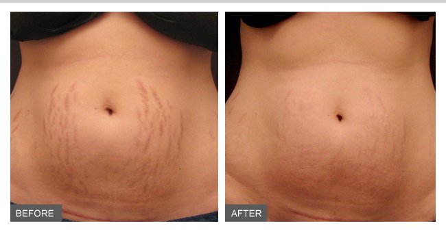 microneedling for stretch marks results